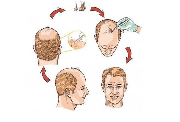 transplante capilar